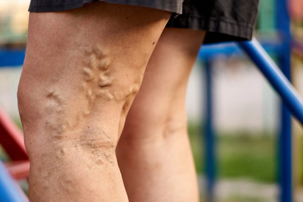 Things To Know About Varicose Vein